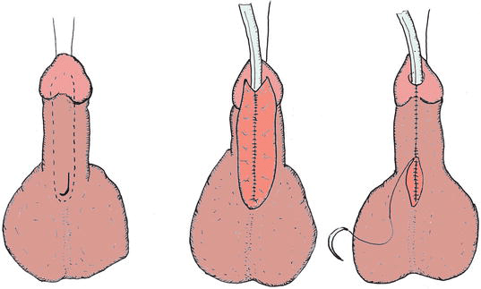 Hyspospadias Surgery