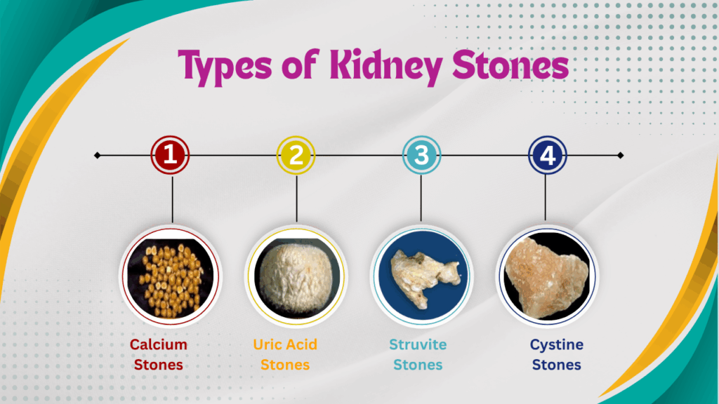 Kidney Stones Symptoms and Treatments